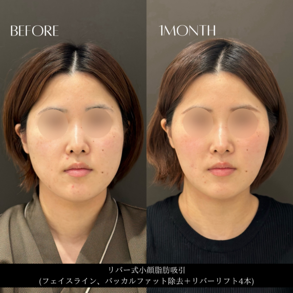 リバー式小顔脂肪吸引　84