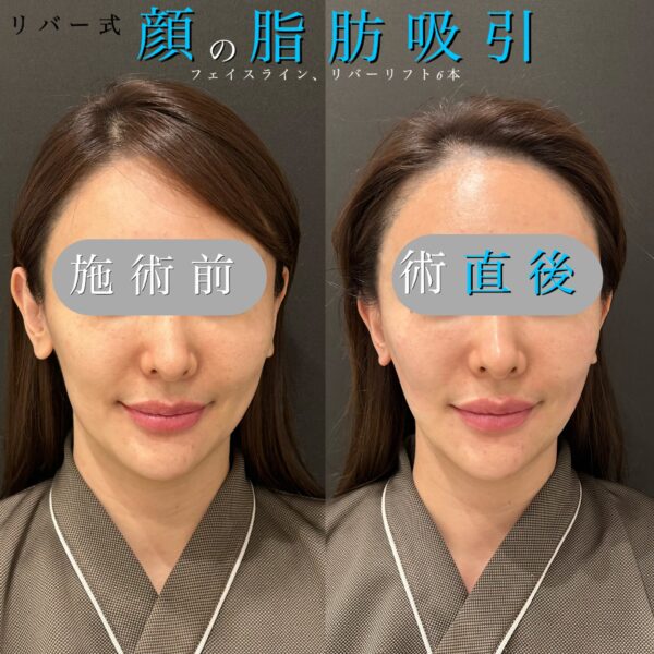 リバー式小顔脂肪吸引　6